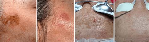 Pigmented Lesion Treatment Vancouver .